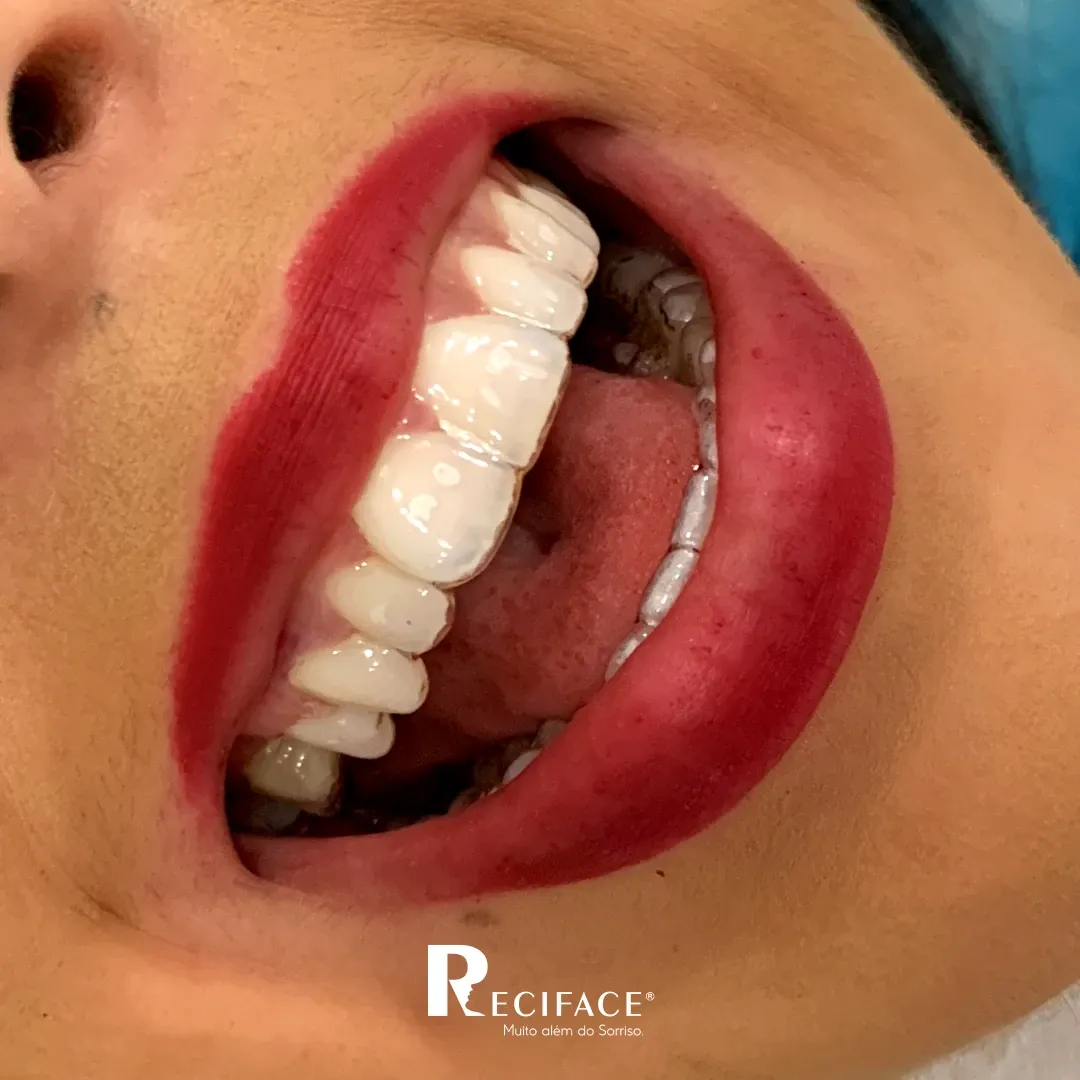 Close de sorriso com alinhador ortodôntico transparente