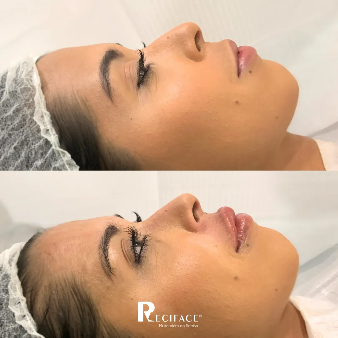 Antes e depois de preenchimento labial